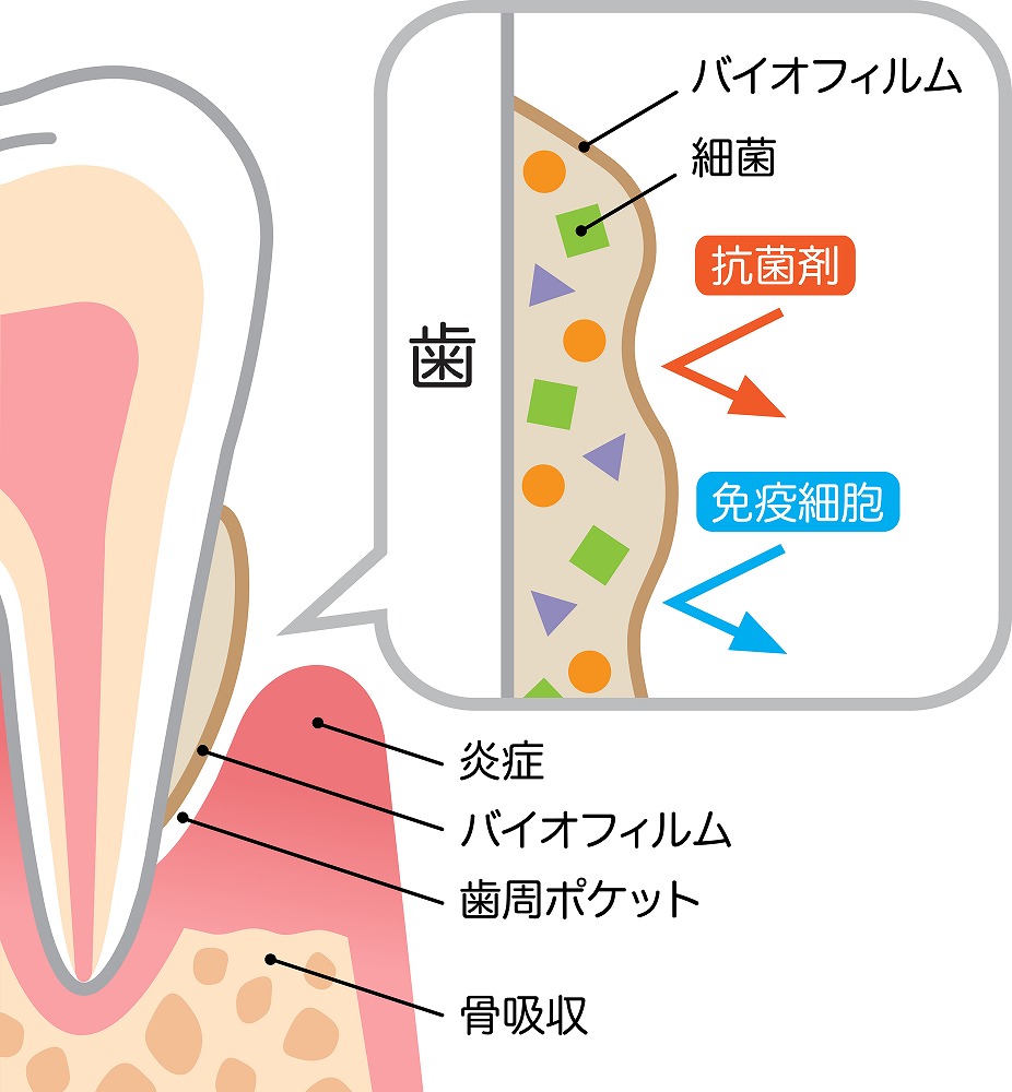 歯周病は早期治療が重要