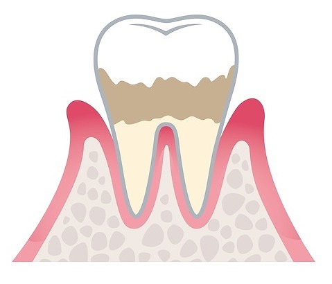 軽度歯周病：スケーリング