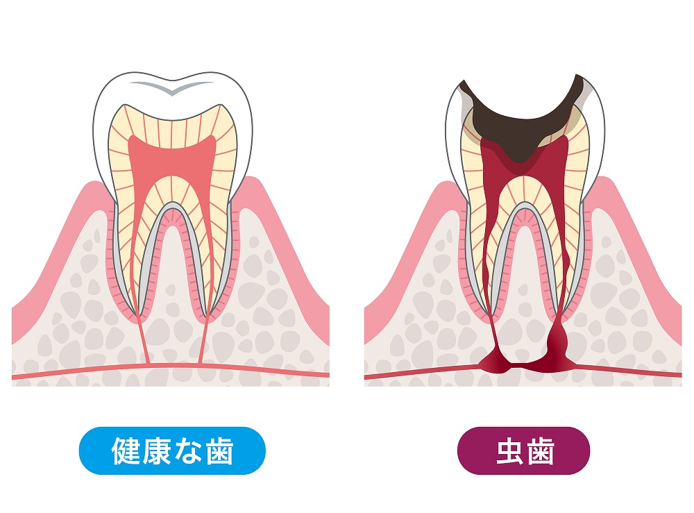 むし歯とは